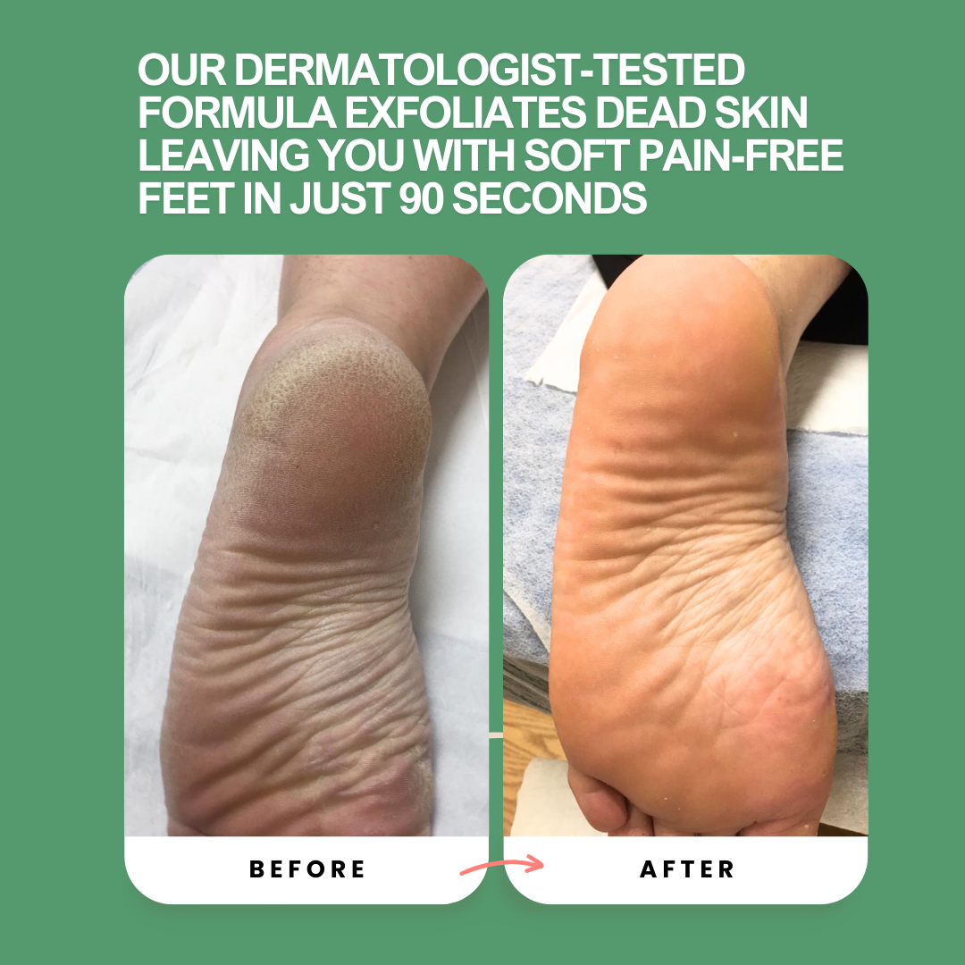 Peele – Instant Foot Peeling Spray